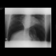 Pneumoperitoneum, massive: X-ray - Plain radiograph